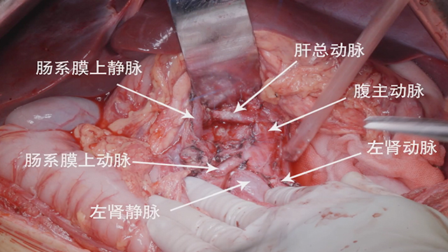 腹膜后肿瘤切除术