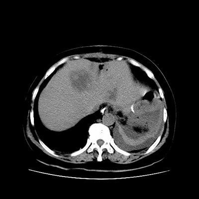肝脓肿影像图片