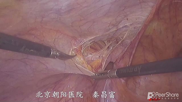 腹腔镜左侧腹股沟疝修补术