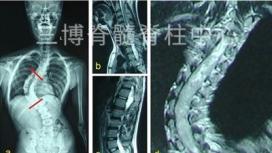 长节段脊髓内星形细胞瘤合并脊柱侧弯的手术报告2例