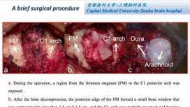 微创减压手术治疗Chiari畸形脊髓空洞