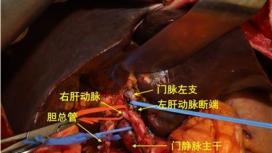 典型肝门部胆管癌行IV型肝门部胆管癌根治术一例